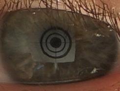 verletztes Auge nach drei Wochen: kaum mehr Veraenderungen sichtbar/three weeks later verletztes Auge nach drei Wochen: kaum mehr Veraenderungen sichtbar/three weeks later